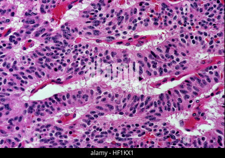 Tumeur carcinoïde typique du poumon, modèle trabéculaire Banque D'Images