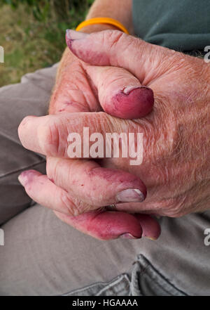 Les doigts tachés d'un asservissement Banque D'Images