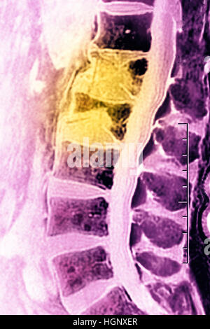 FRACTURE par tassement, IRM Banque D'Images