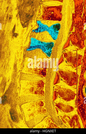 FRACTURE par tassement, IRM Banque D'Images