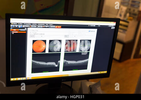 La TOMOGRAPHIE PAR COHÉRENCE OPTIQUE Banque D'Images