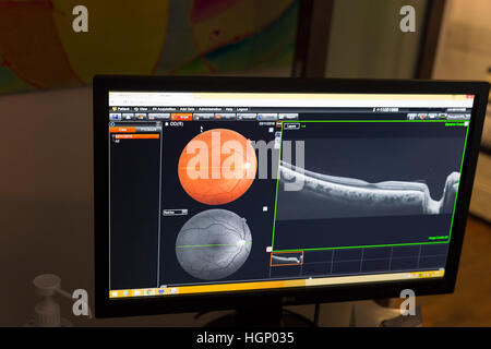 La TOMOGRAPHIE PAR COHÉRENCE OPTIQUE Banque D'Images