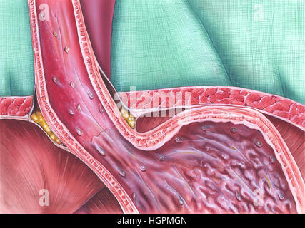 La maladie Gastroesophageal de reflux (GERD), qui se produit lorsque le sphincter oesophagien inférieur (LES) ne se ferme pas correctement, et le contenu de l'estomac remonter (refl Banque D'Images