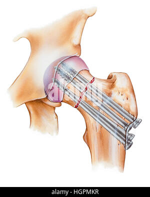 Illustration d'une réparation d'une fracture de la hanche. Montré est une fracture du col du fémur, qui a été réparé avec plusieurs vis d'os spongieux. Banque D'Images