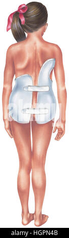 Colonne vertébrale - Scoliose - Jeune fille dans la scoliose corset dorsal - vue postérieure. Banque D'Images
