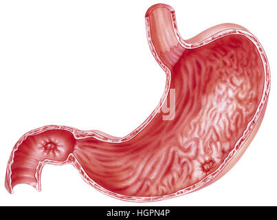 Les ulcères d'estomac - avec Banque D'Images