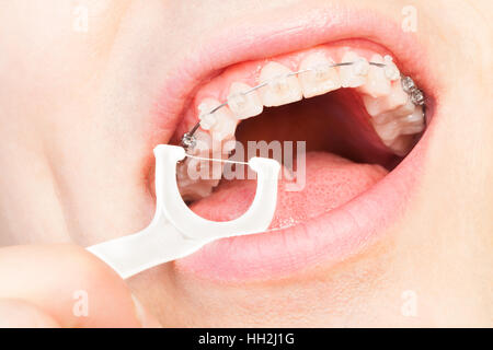 Homme avec appareil dentaire flossing teeth Banque D'Images