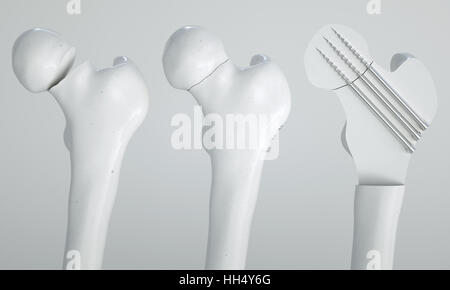 Fracture du fémur - Traitement à l'aide de vis - le rendu 3D Banque D'Images