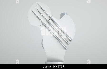 Fracture du fémur - Traitement à l'aide de vis - le rendu 3D Banque D'Images