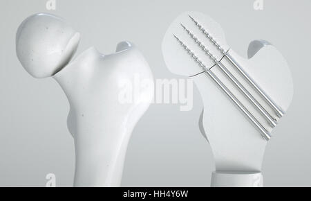 Fracture du fémur - Traitement à l'aide de vis - le rendu 3D Banque D'Images