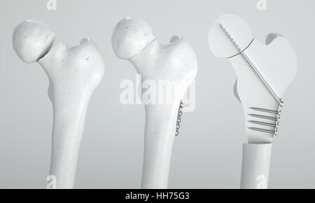 Fracture du fémur - Traitement à l'aide de vis - le rendu 3D Banque D'Images