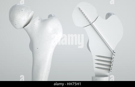 Fracture du fémur - Traitement à l'aide de vis - le rendu 3D Banque D'Images