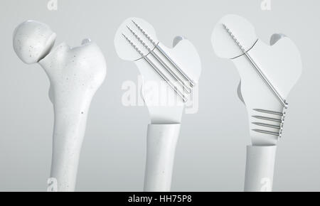 Fracture du fémur - Traitement à l'aide de vis - le rendu 3D Banque D'Images