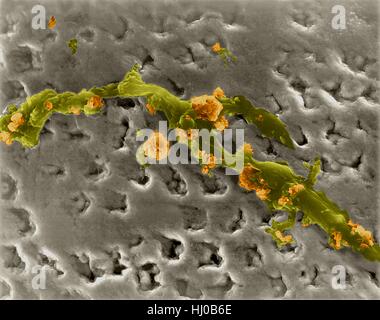 Les droits de l'accumulation de plaque bactérienne de la dent (lisse) tartare calcifiés (aspérités) sur émail,couleur de l'analyse des électrons Microphotographie (SEM).La plaque est une pellicule incolore,collante de bactéries qui se forme sur les dents.Vous pouvez sentir ce film à cause de votre langue maternelle surface et soyeuse sur vos dents.it Banque D'Images