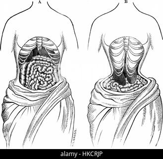 Cette œuvre explore le concept de « laçage serré », une pratique de corseterie extrême commune au XIXe siècle. La peinture traduit le caractère restrictif de la mode, reflétant son importance sociale et culturelle pendant cette période. Banque D'Images