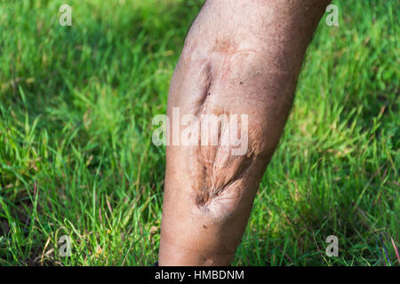 Vieille cicatrice de blessure à la jambe, de voiture ou d'accident de moto, des tissus profonds cicatrice , homme glabre de jambe, blessure à un mollet , grande cicatrice sur le mollet droit. Les cicatrices que Banque D'Images