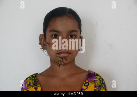 Un Shanaj fille du Bangladesh (10) pose pour une photo à Dhaka Medical College Hospital. Elle affectée par ce qu'on appelle "le syndrome de l'homme arbre", à l'écorce-comme les verrues qui poussent sur son visage pourrait être la première femme jamais atteintes par une maladie rare. Un médecin dit, elle peut être affectée par un trouble génétique rare peau héréditaires. (Photo de Md. Mehedi Hasan / Pacific Press) Banque D'Images