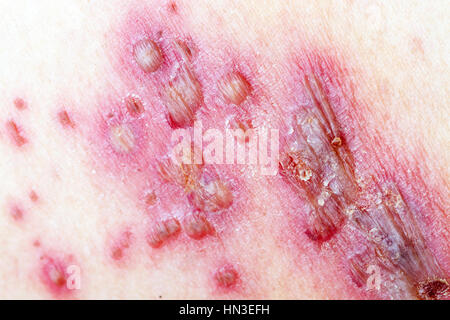 Détail de la peau avec de l'herpès zoster (zona) Banque D'Images