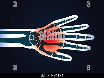 La main de l'os ont un signal rouge. Cette illustration à propos de la douleur de pied. Illustration de Vecteur