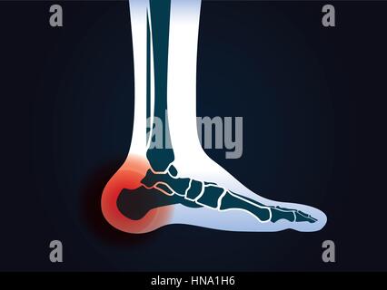 Signal rouge à talon. Cette illustration de la blessure au pied. Illustration de Vecteur