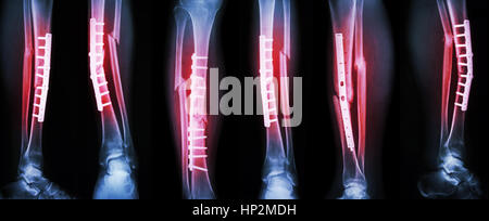 Collection image de fracture de la jambe et un traitement chirurgical par la fixation interne avec la plaque et vis . Briser l'os du tibia et du péroné . Banque D'Images