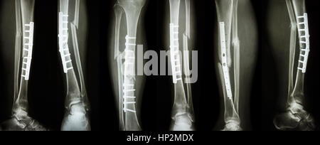 Collection image de fracture de la jambe et un traitement chirurgical par la fixation interne avec la plaque et vis . Briser l'os du tibia et du péroné . Banque D'Images