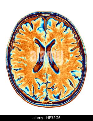 Un cerveau normal. L'imagerie par résonance magnétique de couleur (IRM) d'une section axiale par l'intermédiaire d'un cerveau en santé, les images montrent le cortex et ventricule latéral (en forme de X dans le milieu). Banque D'Images