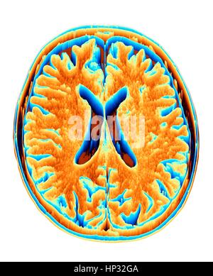 Un cerveau normal. L'imagerie par résonance magnétique de couleur (IRM) d'une section axiale par l'intermédiaire d'un cerveau sain, transformé en un champ de hauteur ou heightmap. Les images montrent le cortex et ventricule latéral (en forme de X dans le milieu). Banque D'Images