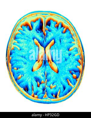 Un cerveau normal. L'imagerie par résonance magnétique de couleur (IRM) d'une section axiale par l'intermédiaire d'un cerveau sain, transformé en un champ de hauteur ou heightmap. Les images montrent le cortex et ventricule latéral (en forme de X dans le milieu). Banque D'Images