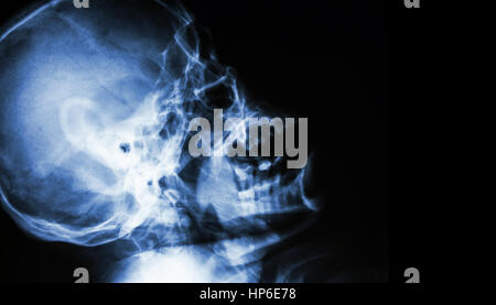 Film X-ray de crâne humain normal . vue latérale . zone vide du côté droit . Banque D'Images
