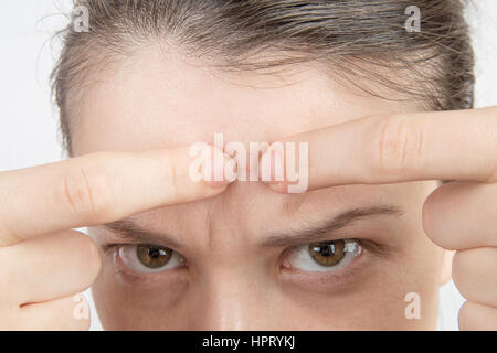 Jeune fille avec des problèmes de peau acné sur le visage close up Banque D'Images