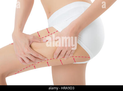 L'accaparement de femme peau sur sa cuisse avec le dessin des flèches rouges, perdre du poids et la cellulite liposuccion dépose concept, isolé sur fond blanc. Banque D'Images