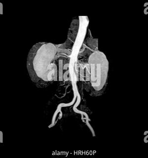 Aorte abdominale et les reins Banque D'Images