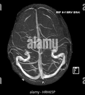 Résonance magnétique intracrânienne Venogram Banque D'Images