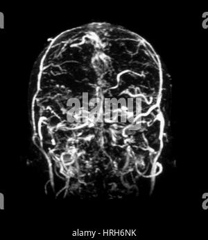 L'IRM de Venogram de thrombose de Sinus Dural Banque D'Images