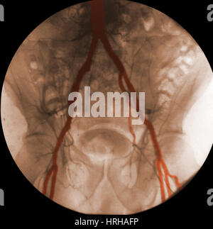 Artères iliaques d'Angiographie Banque D'Images