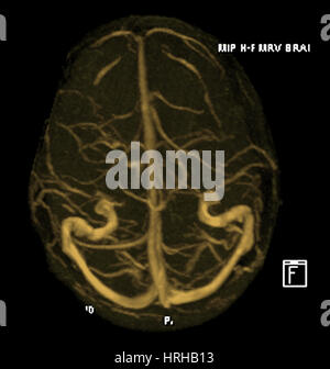 Résonance magnétique intracrânienne Venogram Banque D'Images