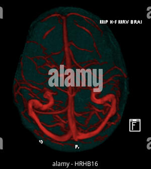 Résonance magnétique intracrânienne Venogram Banque D'Images