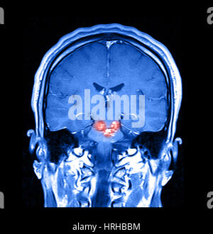 Malformations caverneuses du tronc cérébral IRM Banque D'Images