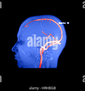 Anatomie veineuse normale Banque D'Images