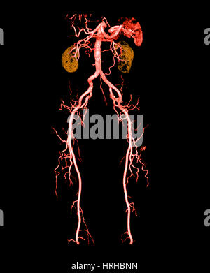 Angioscanner de l'abdomen et les jambes Banque D'Images