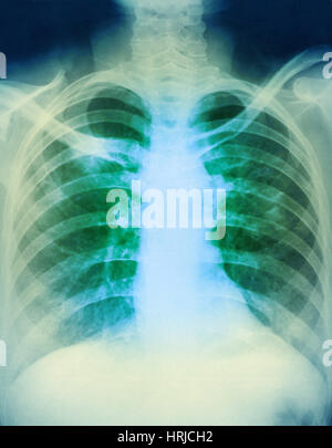 Le lymphome de Hodgkin, X-ray Banque D'Images