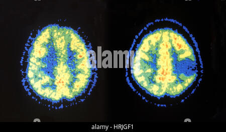 La TEP du cerveau normal et pathologique Banque D'Images