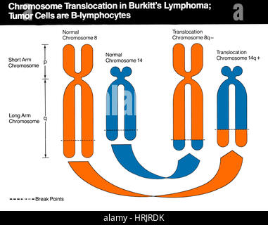 Le lymphome de Burkitt Banque D'Images