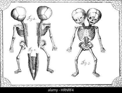 Jumeaux siamois, 18e siècle Banque D'Images
