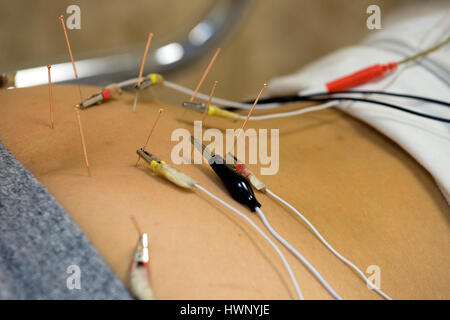 Un patient recevant electro acupuncture, Hong Kong, Chine. Banque D'Images