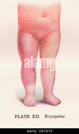 L'érysipèle est une infection bactérienne de la peau caractérisée par une peau rouge, gonflée et enflammée. Affectant souvent le visage et les jambes, cette condition est causée par la bactérie Streptococcus. L'érysipèle nécessite généralement un traitement antibiotique et peut entraîner des complications s'il n'est pas traité. Banque D'Images