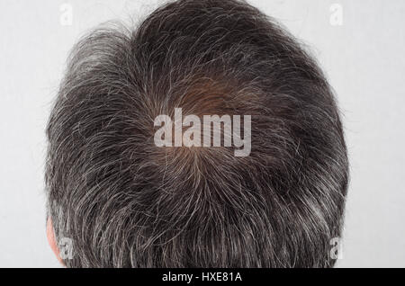 La perte de cheveux et les cheveux gris, tête d'homme avec des symptômes de perte de cheveux Banque D'Images