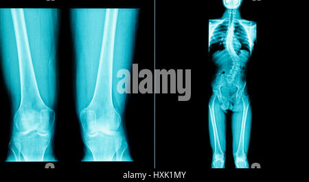 X-ray image des droits de l'avoir un os long corps Banque D'Images