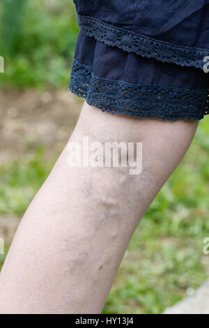 Femme avec des varices douloureuses et de varicosités sur les jambes. Maladies vasculaires, problèmes de varices douloureuses inesthétique, condition médicale concept. Banque D'Images